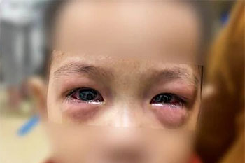Dịch đau mắt đỏ xuất hiện, nhiều trẻ gặp biến chứng nặng